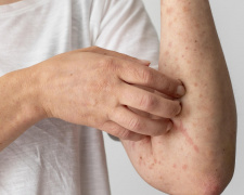 Спалах кору на Дніпропетровщині: у закладі освіти за тиждень захворіли троє людей