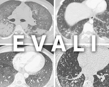 Що таке хвороба вейперів EVALI і чи дійсно вона вбиває