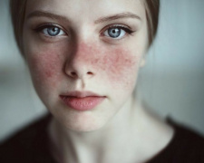 На Дніпропетровщині лікарі б'ють на сполох через випадки червоного вовчака у підлітків: подробиці