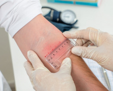 Кінець «гудзику»: чим замінять пробу Манту в Україні вже у квітні