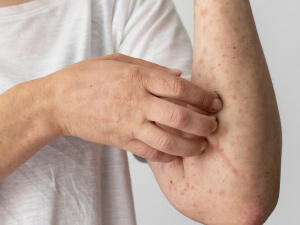 Спалах кору на Дніпропетровщині: у закладі освіти за тиждень захворіли троє людей