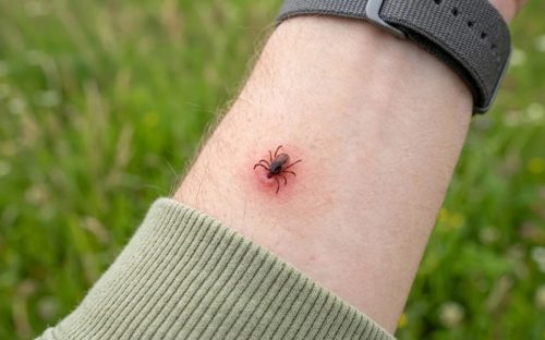 Понад 90 випадків за пів року: на Дніпропетровщині стрімко поширюється хвороба Лайма