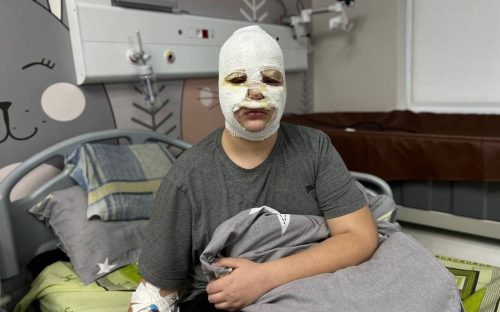 Небезпечний експеримент з ТікТоку: юнак з Кам'янського отримав хімічні опіки через тренди в соцмережах