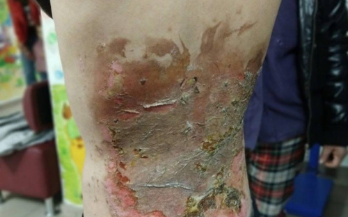На Дніпропетровщині 13-річний хлопчик отримав опіки, виготовляючи вибуховий коктейль