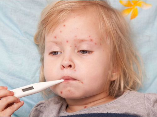 Епідемічна ситуація на Дніпропетровщині: зростання ГРВІ та спалах кору