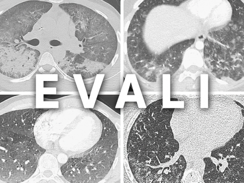 Що таке хвороба вейперів EVALI і чи дійсно вона вбиває