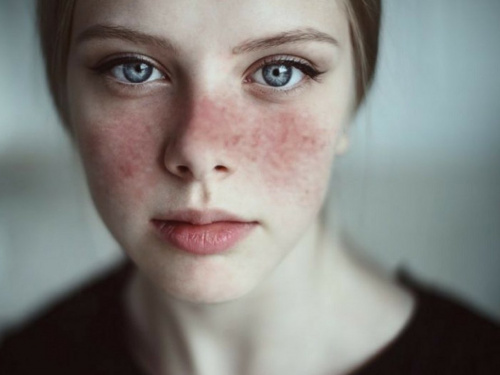 На Дніпропетровщині лікарі б'ють на сполох через випадки червоного вовчака у підлітків: подробиці