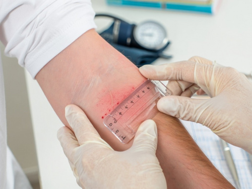 Кінець «гудзику»: чим замінять пробу Манту в Україні вже у квітні