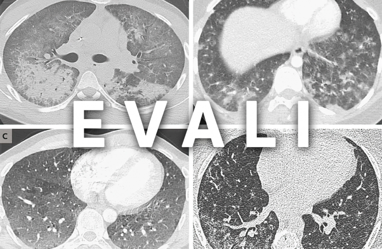 Що таке хвороба вейперів EVALI і чи дійсно вона вбиває