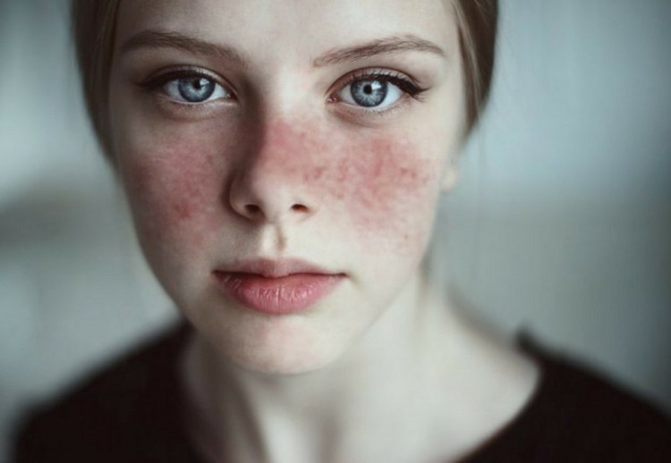 На Дніпропетровщині лікарі б'ють на сполох через випадки червоного вовчака у підлітків: подробиці