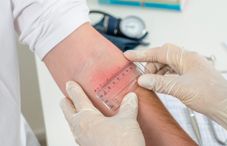 Кінець «гудзику»: чим замінять пробу Манту в Україні вже у квітні